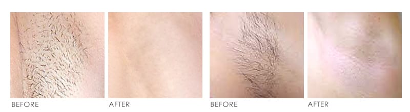 laser hair removal Before After