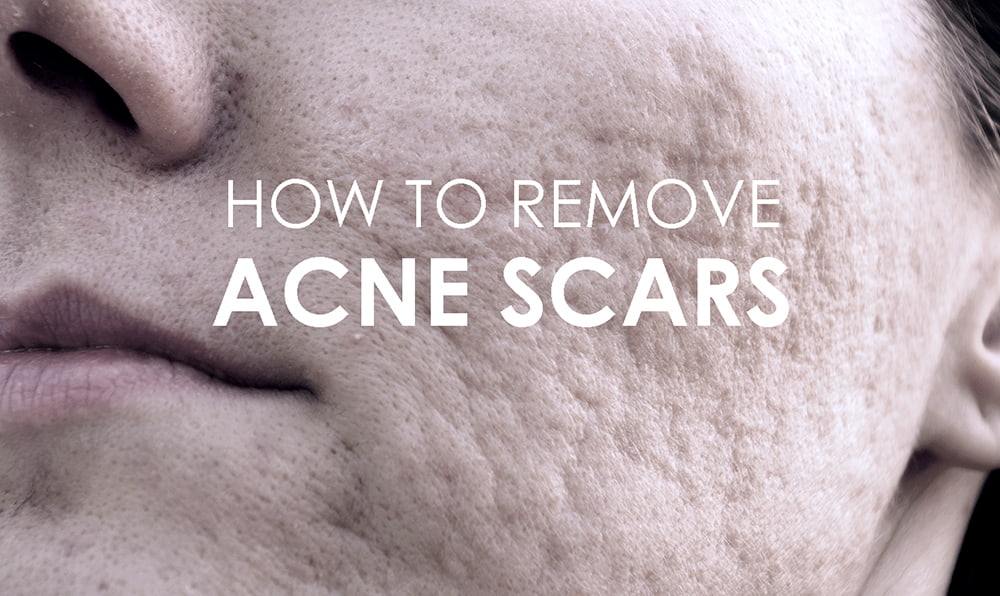 What Are Acne Scars and How to Get Rid of Them | Premier Clinic