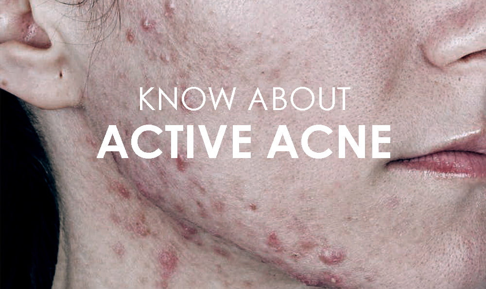 Active acne 2024