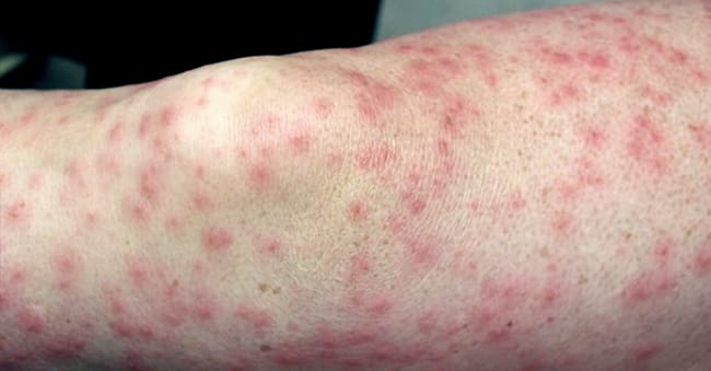Allergic contact dermatitis