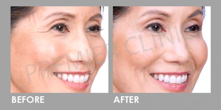 Before & After Botulinum Toxin