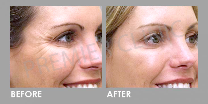 Before & After Botulinum Toxin