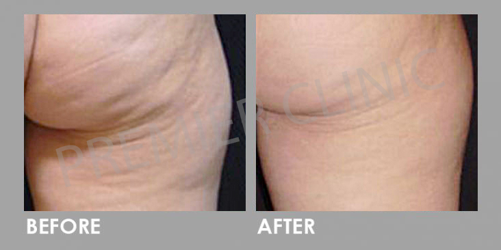 Cellulite removal Before After