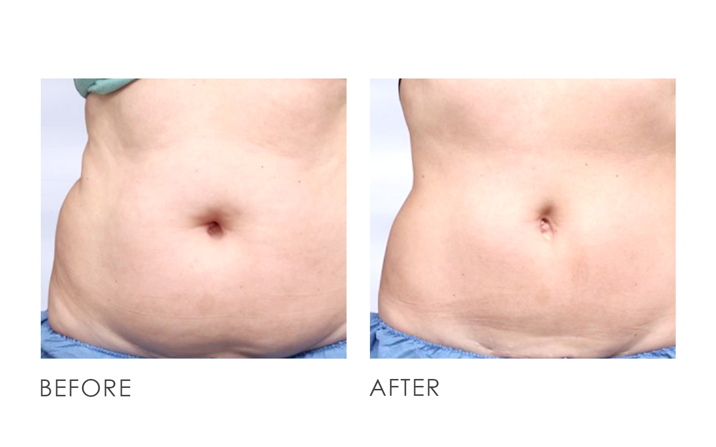 CoolSculpting Before After 02