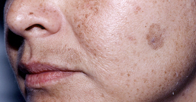 Age Spots On The Face Causes Symptoms Premier Clinic