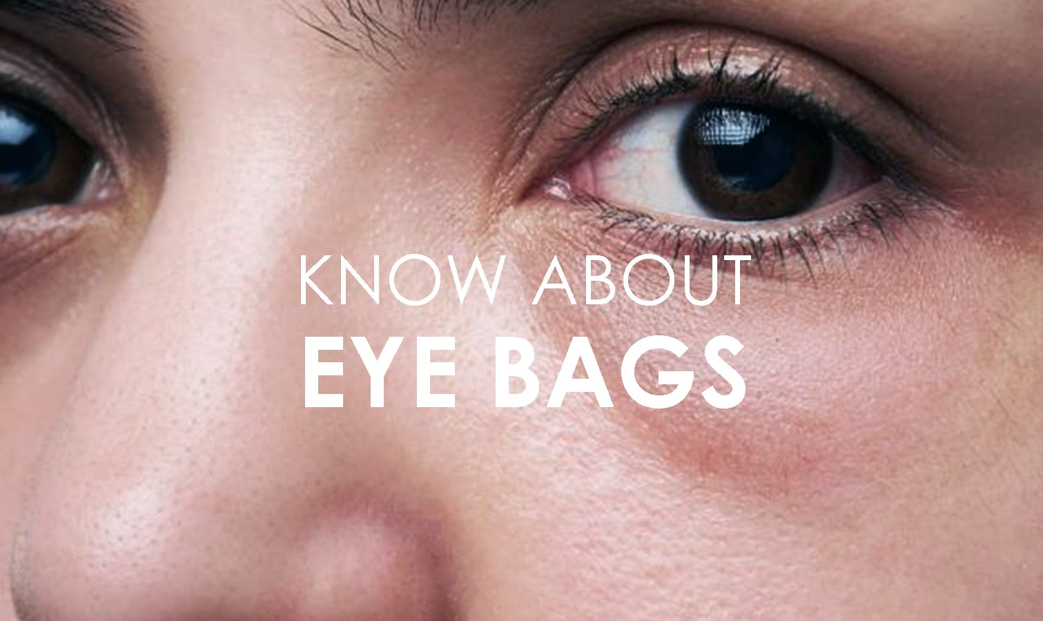 Types of Eye bags