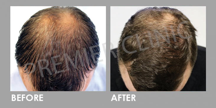 Premier Clinic FUE Hair Transplant Before After