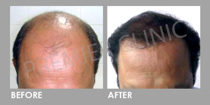 FUE Hairtransplant Before After
