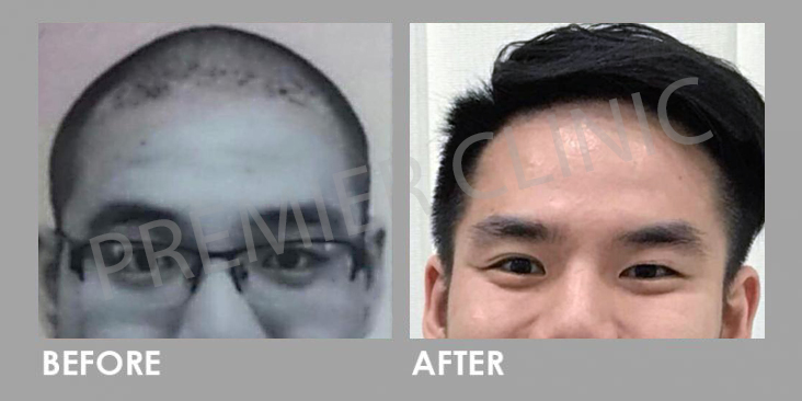 FUE Hairtransplant Before After 