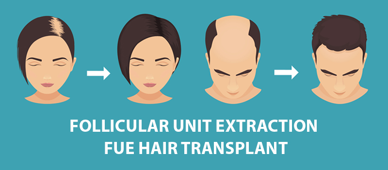 Follicular Unit Extraction Hair Transplant