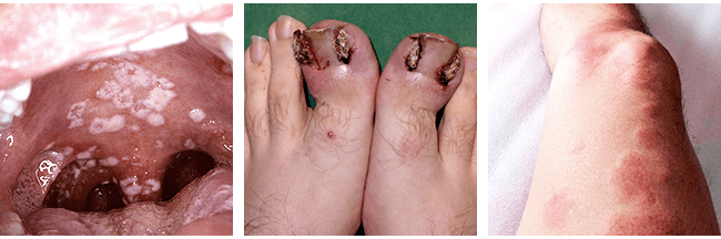 Fungal Infections Usually Appear