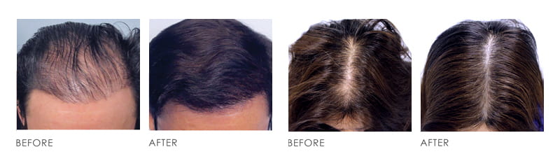 Hair Transplaint Before After