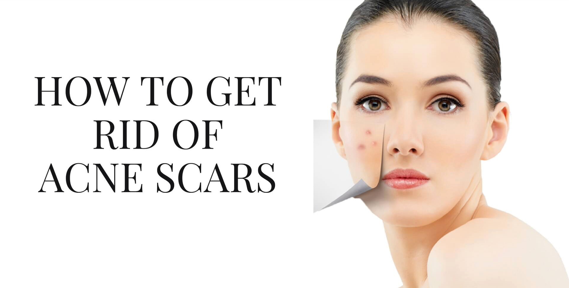 How To Get Rid Of Acne Scars