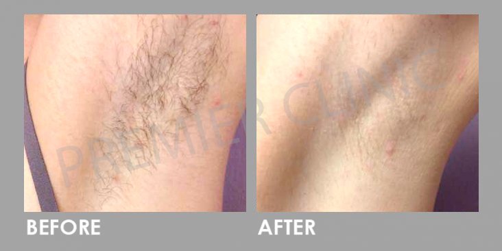 Laser Hair Removal Before After