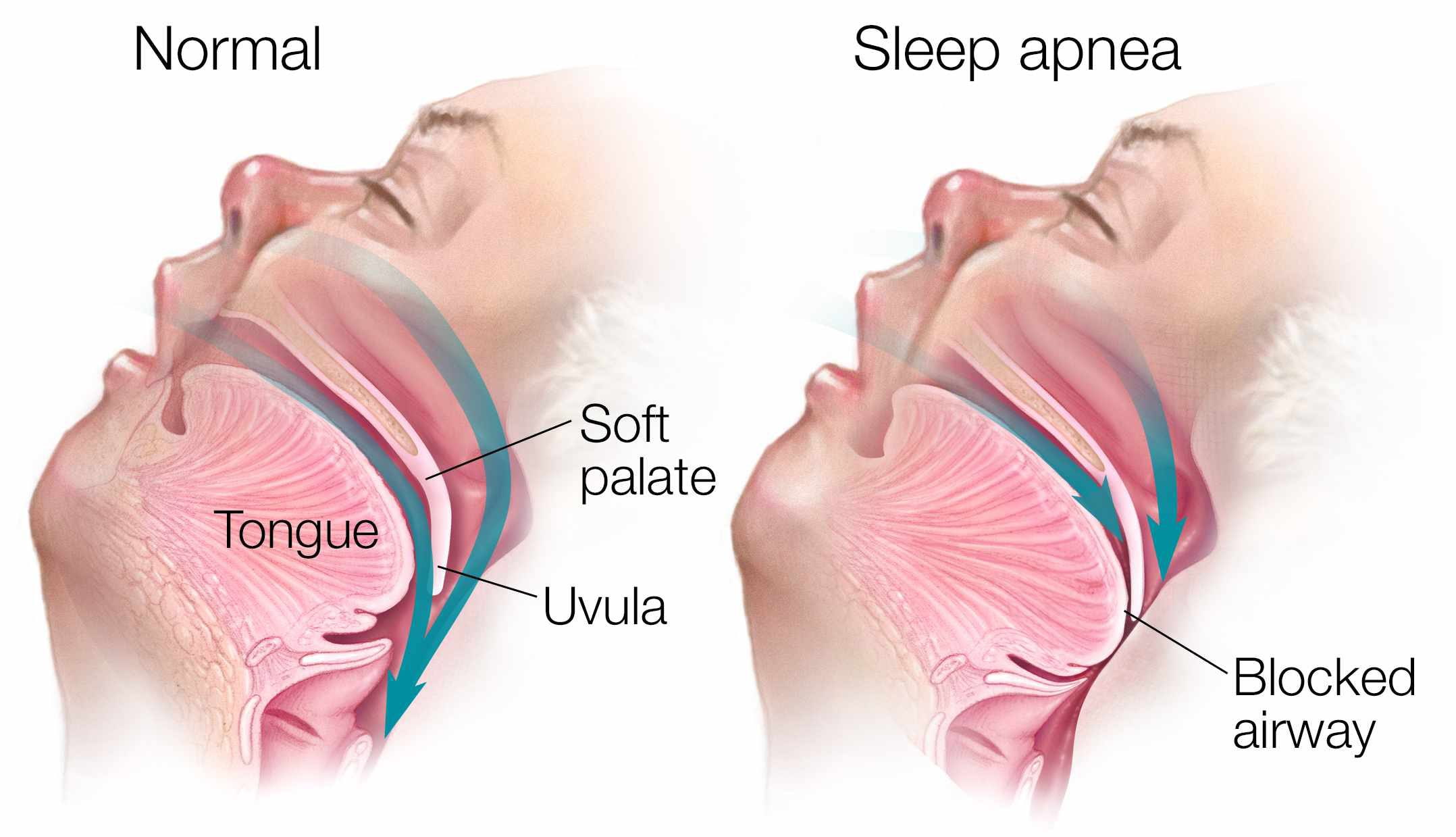 Medical-illustration-of-sleep-apnea