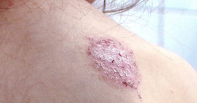 Nummular eczema