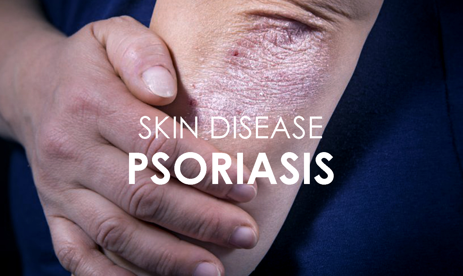 Psoriasis Skin Disease