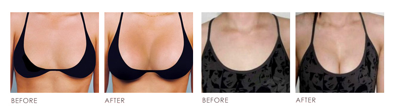 Breast Augmentation & Enlargement