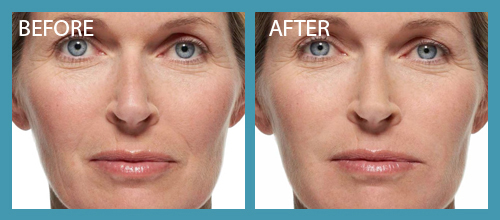 Radiesse Filller Before After Premier Clinic 04
