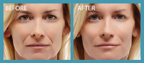 Radiesse Filller Before After Premier Clinic 04