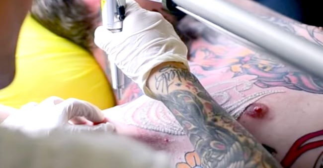 Risks of Removing Tattoos