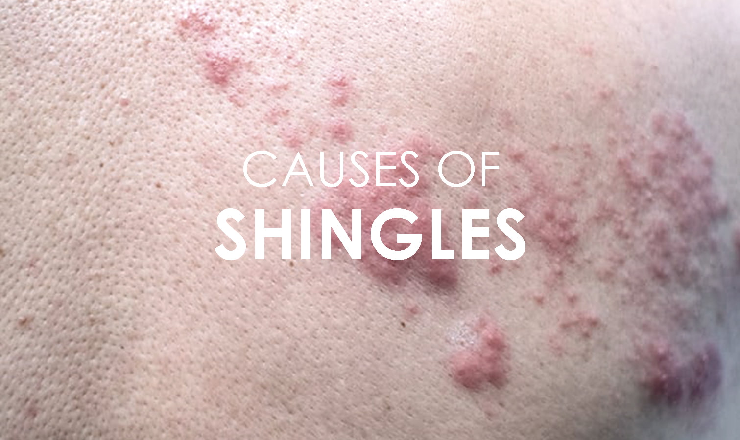 Shingles Disease Causes Symptoms And Treatments Premier Clinic