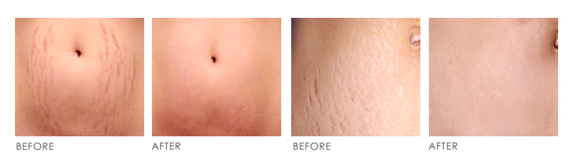 STRETCH MARK Before After