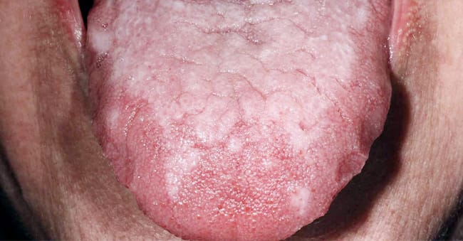 Sores on the mouth