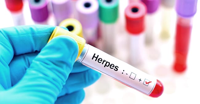 Symptoms of Herpes