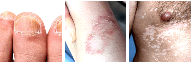 Symptoms of a Fungal Infection