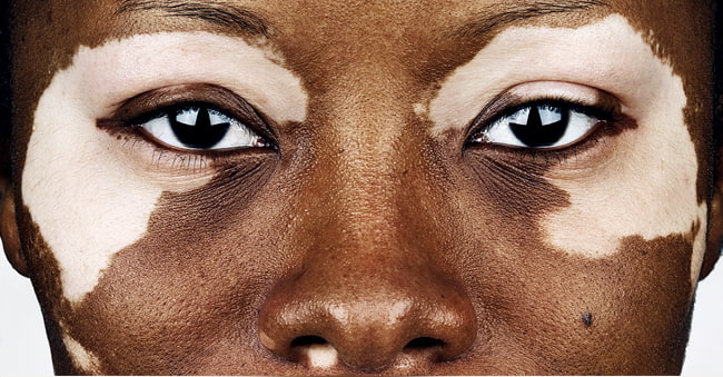Vitiligo Skin Disease Causes Symptoms And Treatments Premier Clinic