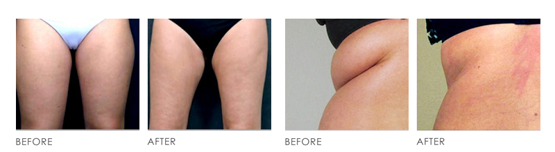 Vanquish Fat Reduction Treatment before after
