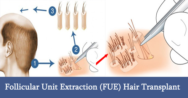 follicular-unit-extraction-fue-hair-transplant