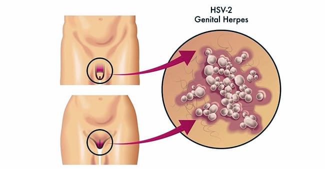herpes simplex virus HSV