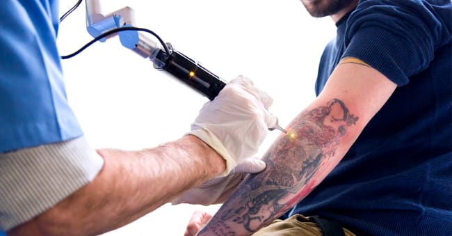 laser Removing Tattoos