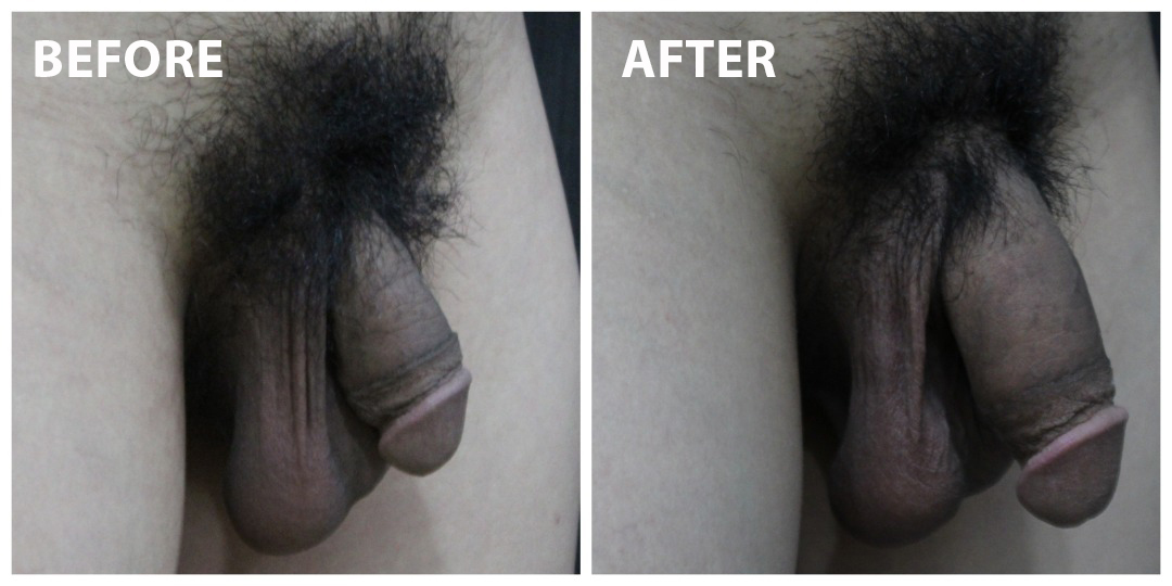 Penis Enlargement Before & After KL