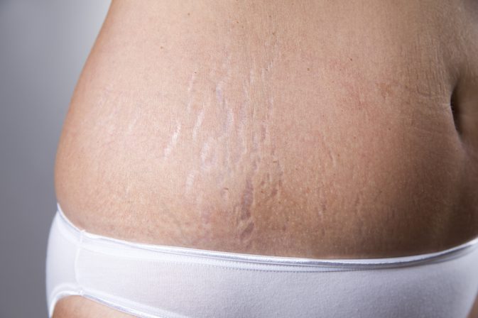 Laser Away Your Stretch Mark