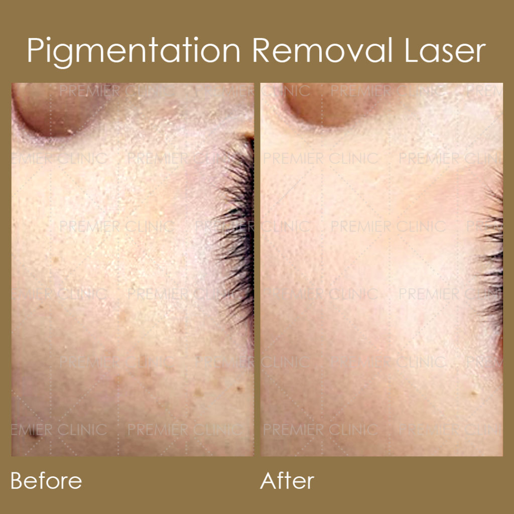 Pigmentation Removal Laser Before & After 
