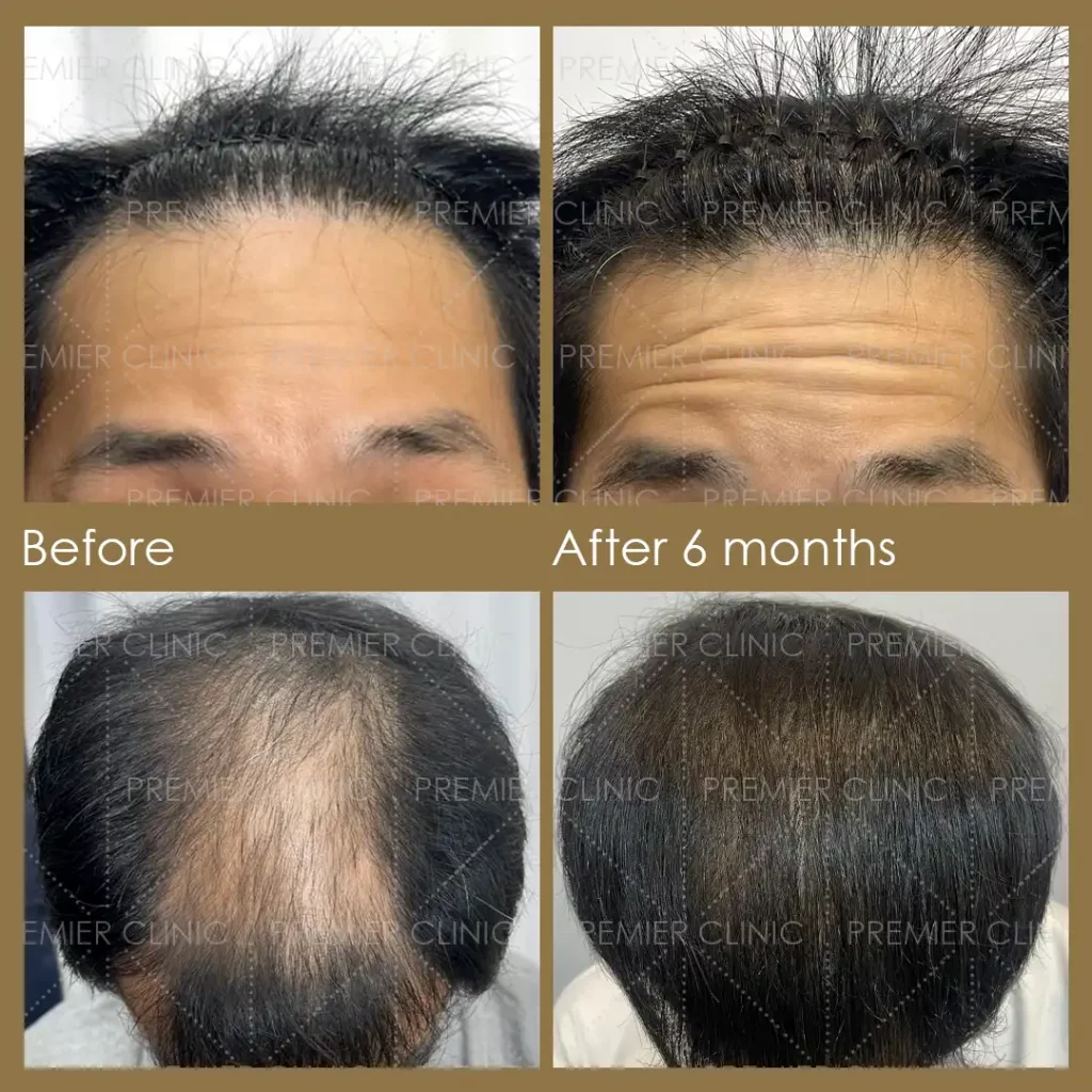 Premier FUE Hair Transplant Before & After procedure - Natural-looking Results 