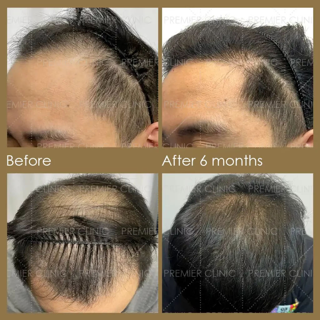Premier FUE Hair Transplant Before & After procedure - Natural-looking Results 