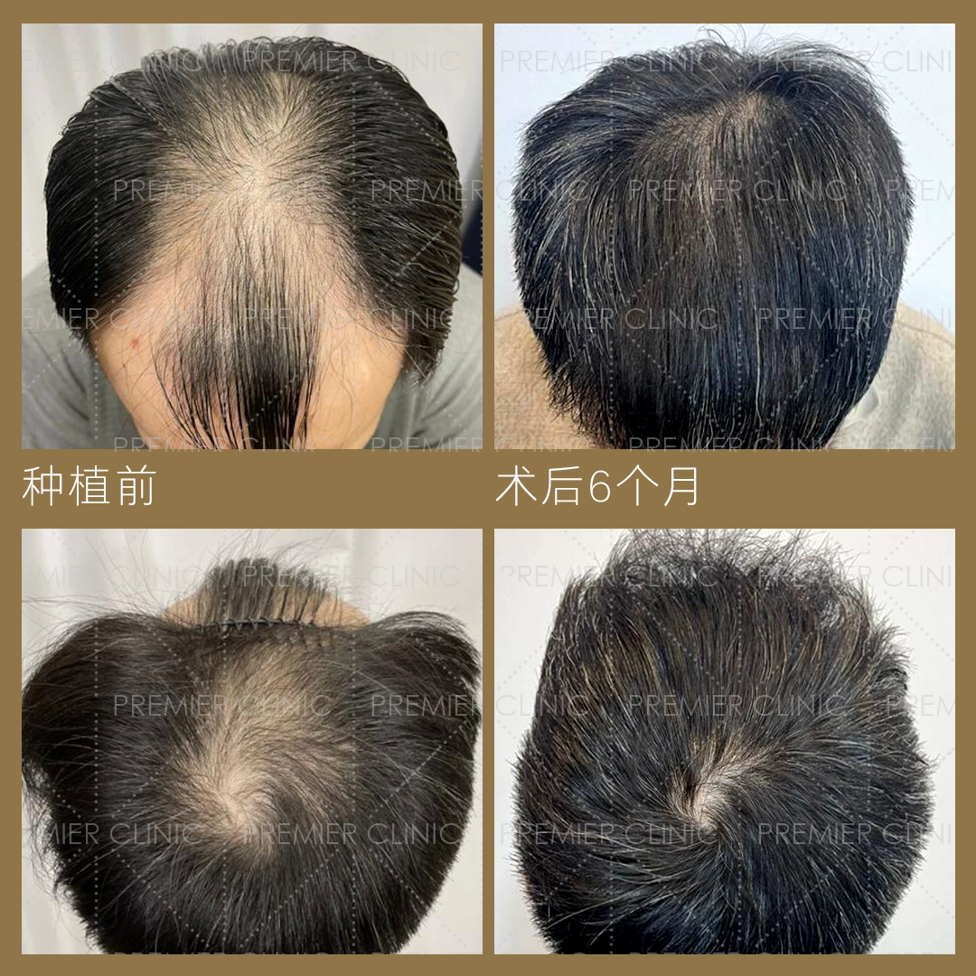 无痕头发移植治疗前后