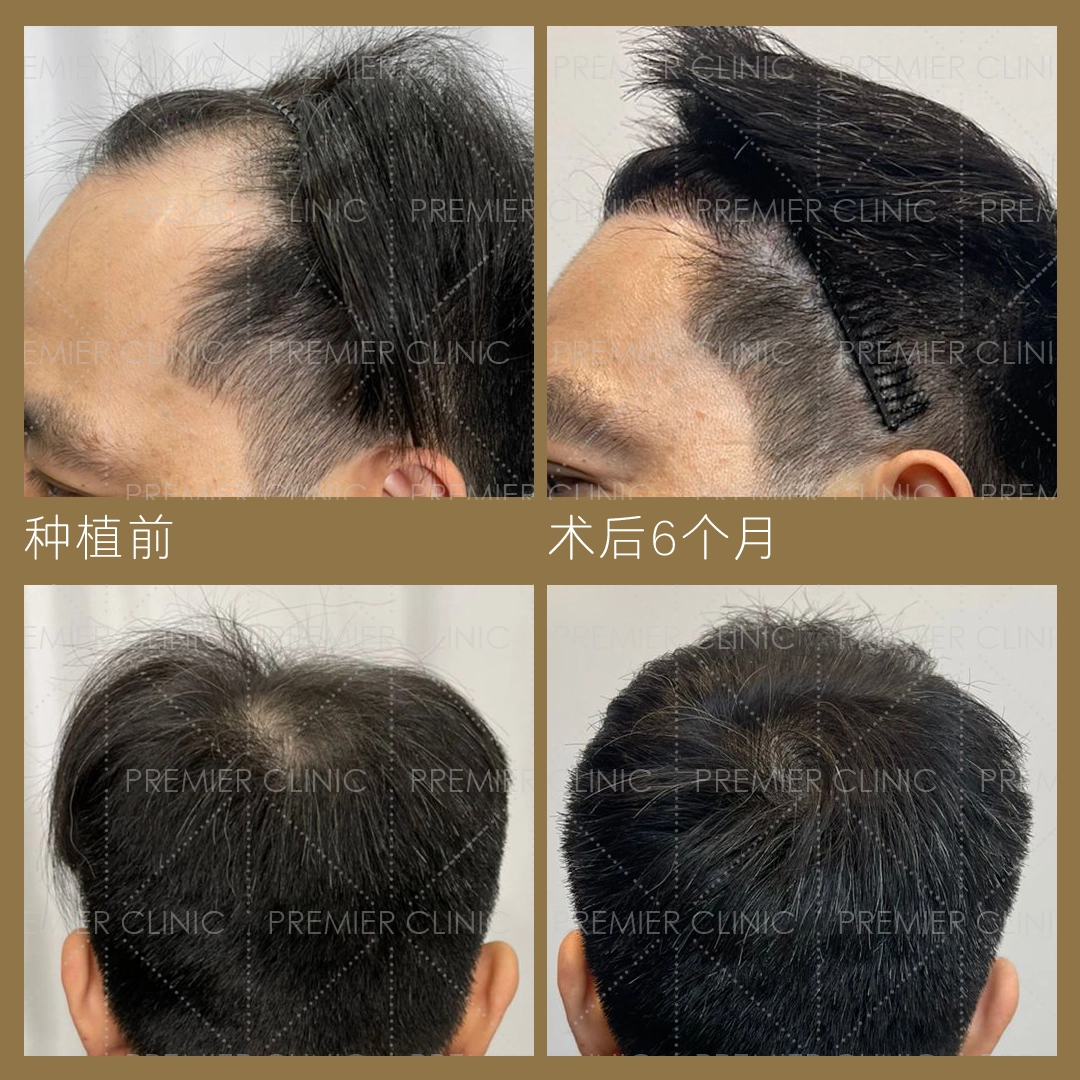 无痕头发移植治疗前后