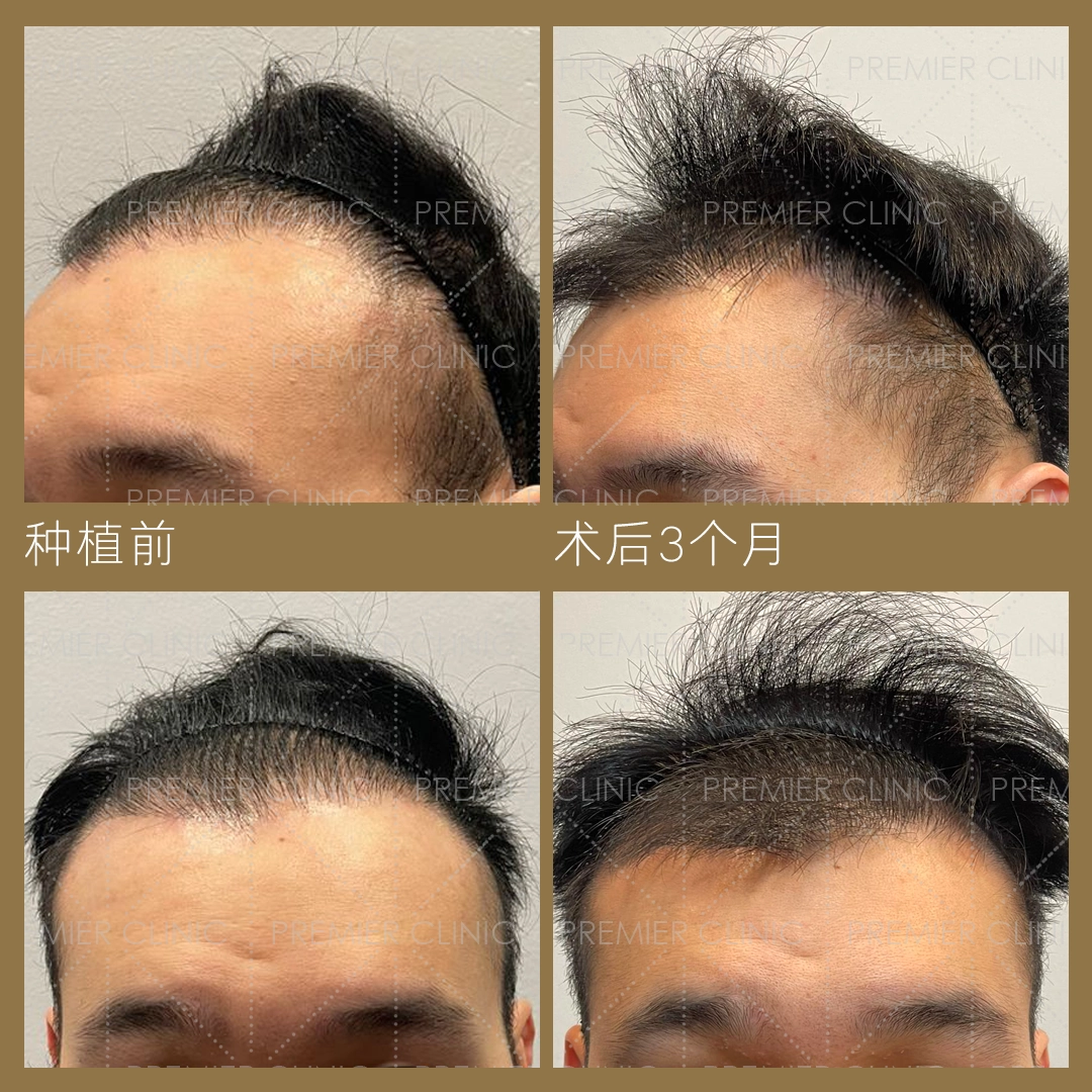 无痕头发移植治疗前后