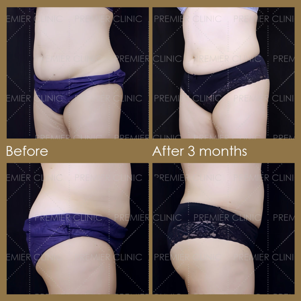  Premier Fat Loss Before & After 