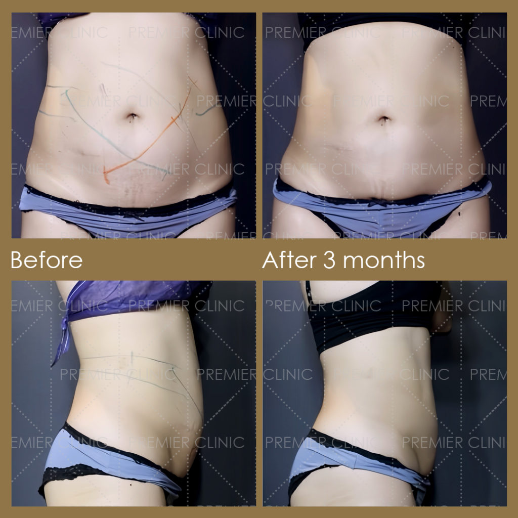  Premier Fat Loss Before & After 