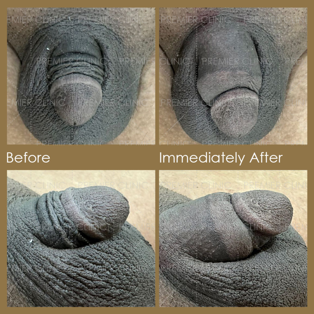 Premier Penis Enlargement Filler Injection Before & After Results