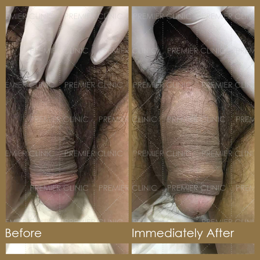 Premier Penis Enlargement Filler Injection Before & After Results