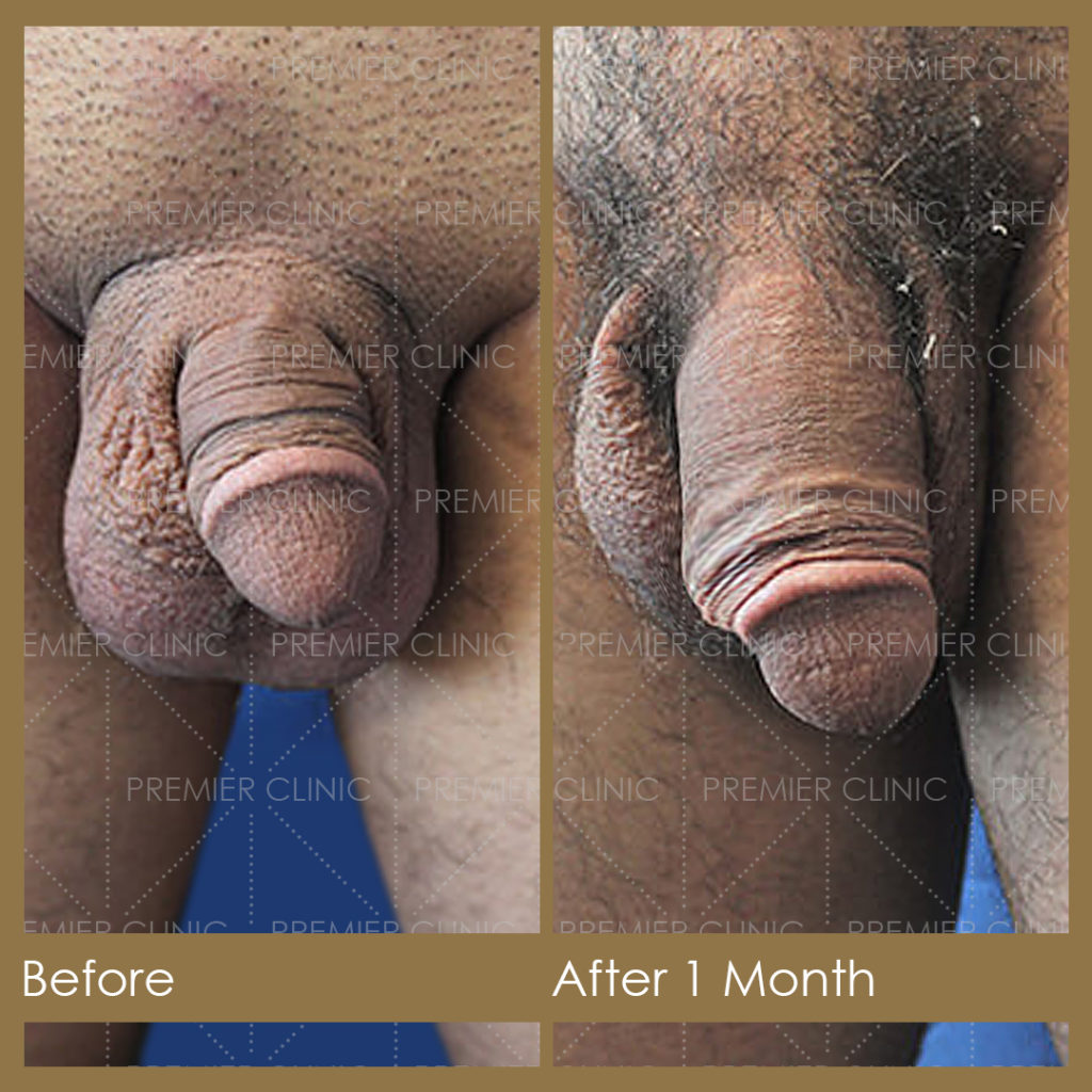 Premier Penis Enlargement Filler Injection Before & After Results