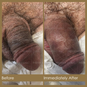 Premier Penis Enlargement Filler Injection Before & After Results