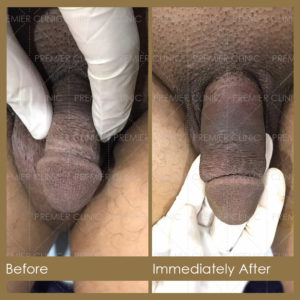 Premier Penis Enlargement Filler Injection Before & After Results